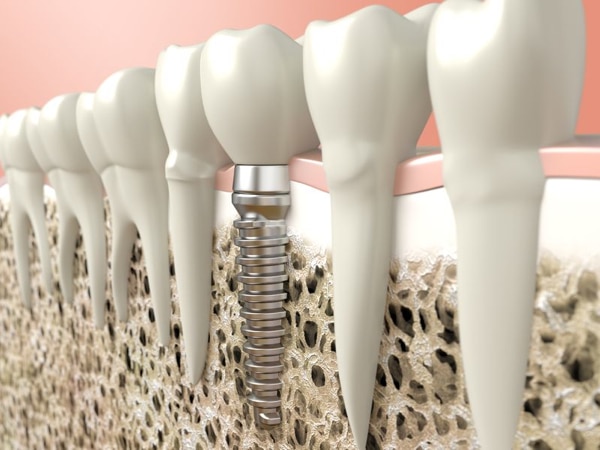 Dental implants in Vancouver