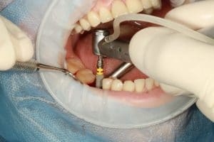 Single Tooth Dental Implant Vancouver