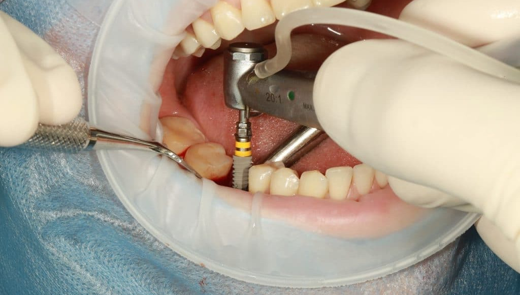 Advantages Of Single-Tooth Dental Implants | Vancity Dental Vancouver